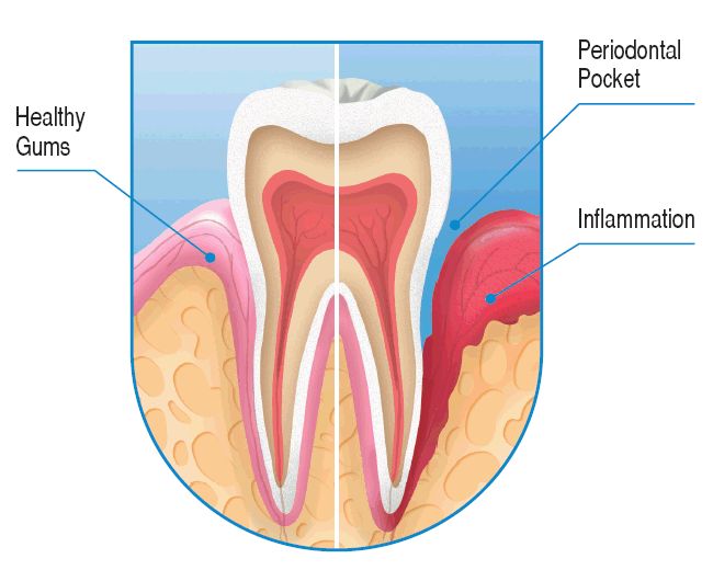 Periodontosis