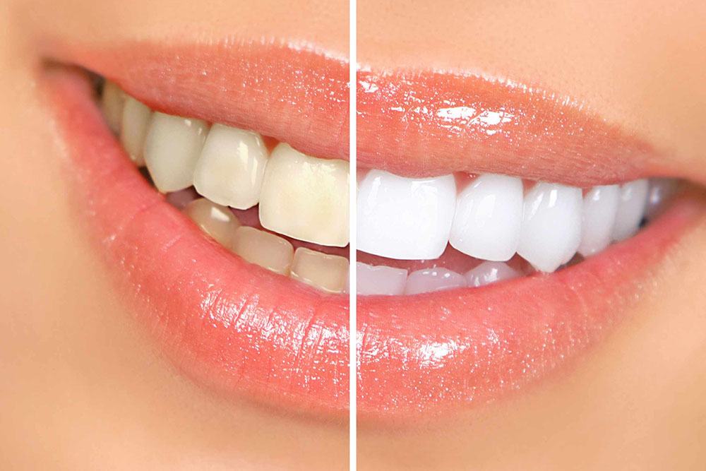 Tooth whitening