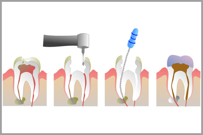 Endodoncija